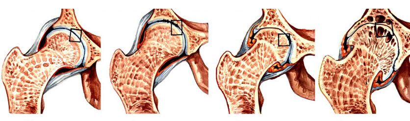 artrozė iš dešinės rankos sąnario