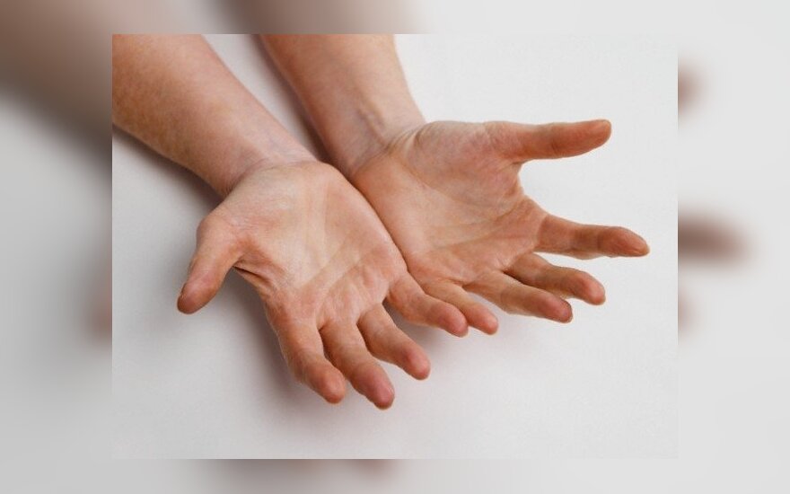 artritas iš alkūnės sąnario komplikacija