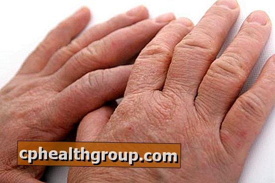 artritas išsipūsti savo rankas kas tabletes gerti su skausmais sąnariuose