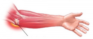 artrozė iš alkūnės sąnario blokados tepalas už artrozės sąnario gydymo