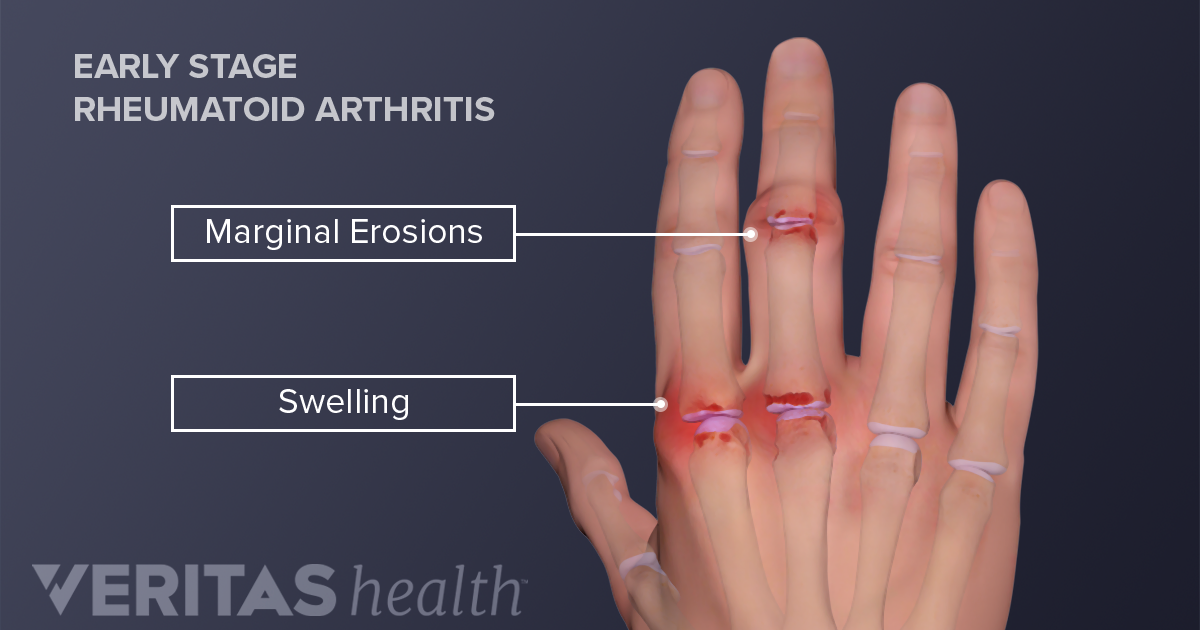 swollen painful joints not arthritis