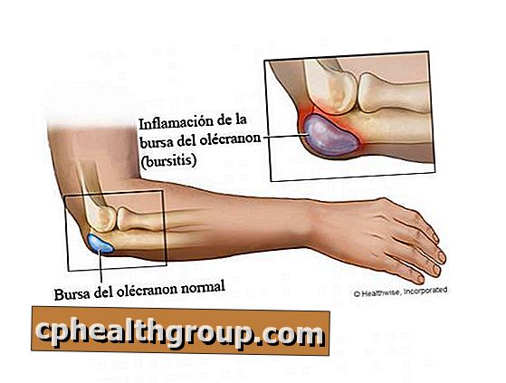 keičia į bendrą artrozės ką daryti kai pėdos sąnarių skauda