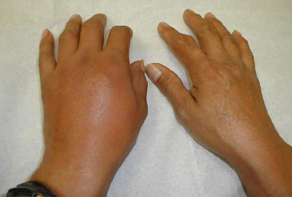 šalinama uždegimą rankų sąnarius pirštai po artrito