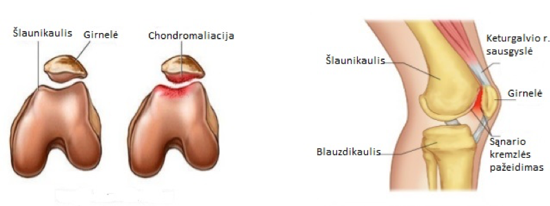 nugaros skausmas ir sąnarių swelling painful joints in fingers and toes