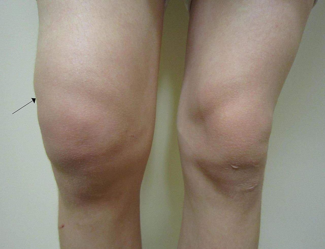 crunching pirštai artritas uždegimas nuo pirštų gydymo pėdos sąnarių liaudies gynimo priemones