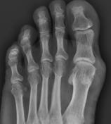 podagra arthritis radiology