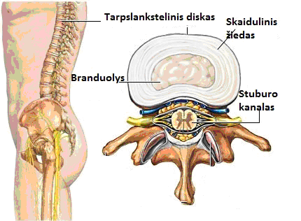 osteochondrozės gydymas edema synovial joints