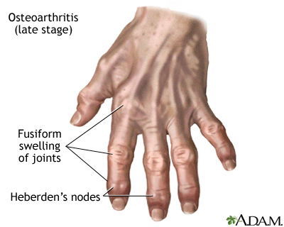 joint edema osteoarthritis bursitas sąnarių uždegimą