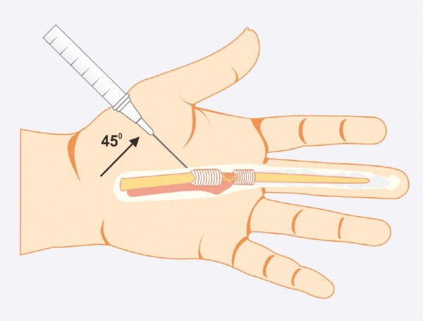 gerklės bendru didžiuoju pirštu ant rankos ką daryti pranešimo stramatic artritas pirštų
