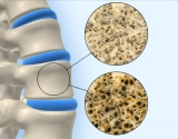 gydymas arthroz kojų 2 etapai priežastis uždegimas pirštų sąnarių
