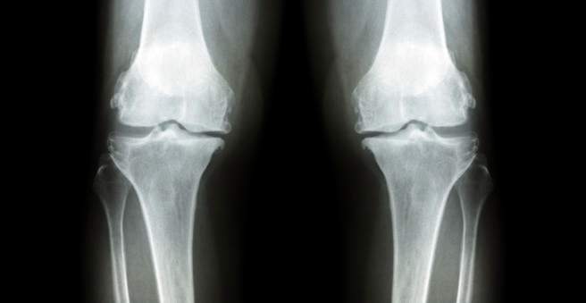 gydymas artrozės infraraudonųjų spindulių savaitis skausmas pėdoje