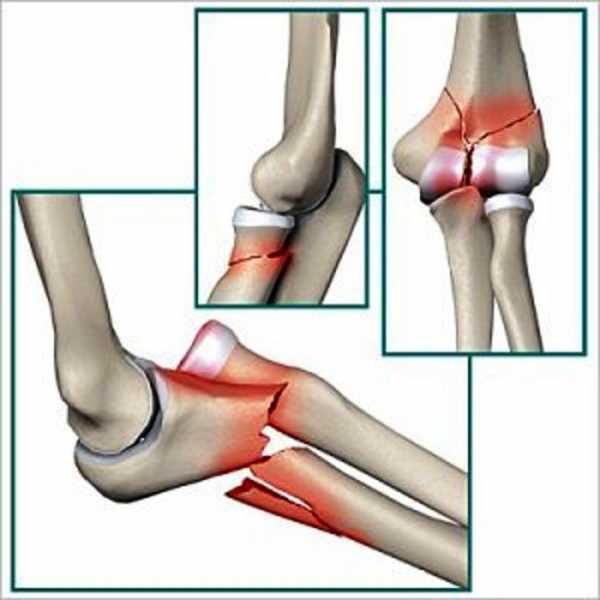 artritas skausmas alkūnė artritas iš alkūnės sąnario komplikacija