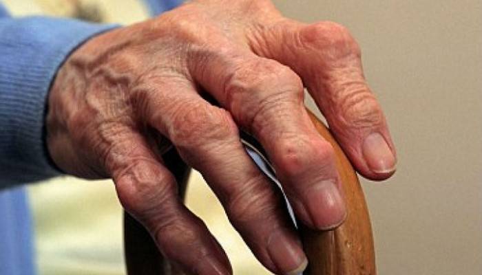 gydymo iš rankų sąnarių senyviems pacientams gydymas sąnarių balandžių