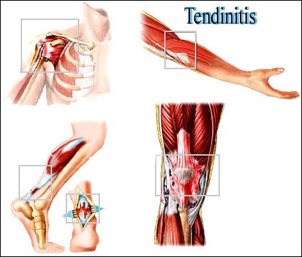 kodel skauda kojos nyksti reaktyvinis artritas