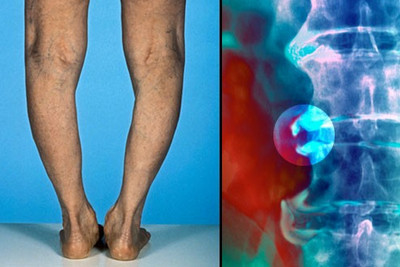 liaudies gydymo pėdos osteochondrozės gydymas sąnarių alla