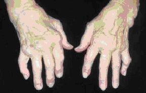 ligos nuo kaulų sąnarių rankas epstein-barr liga sąnarių