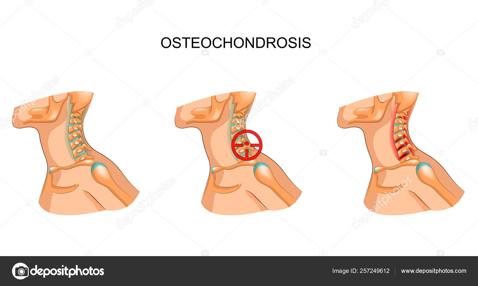 osteochondrose gelis