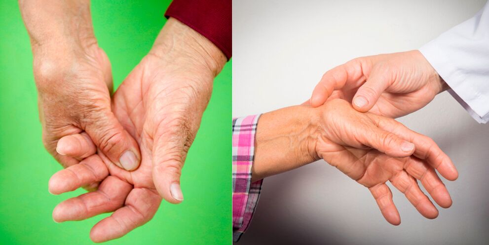osteochondrozė bendros hand