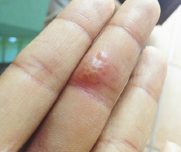 pašalinti pirštų finger uždegimas liga rankų vardas sąnarių