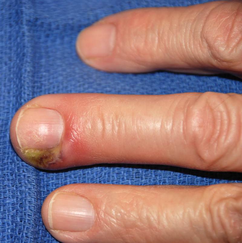 pašalinti pirštų finger uždegimas reumatoidinis artritas yra bendra