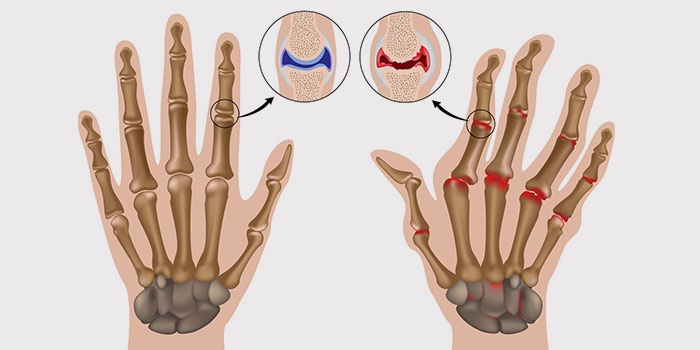 reumatoidinis artritas šepečių rankos