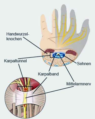 rieso kanalo sindromas gerklės sąnarių riešų