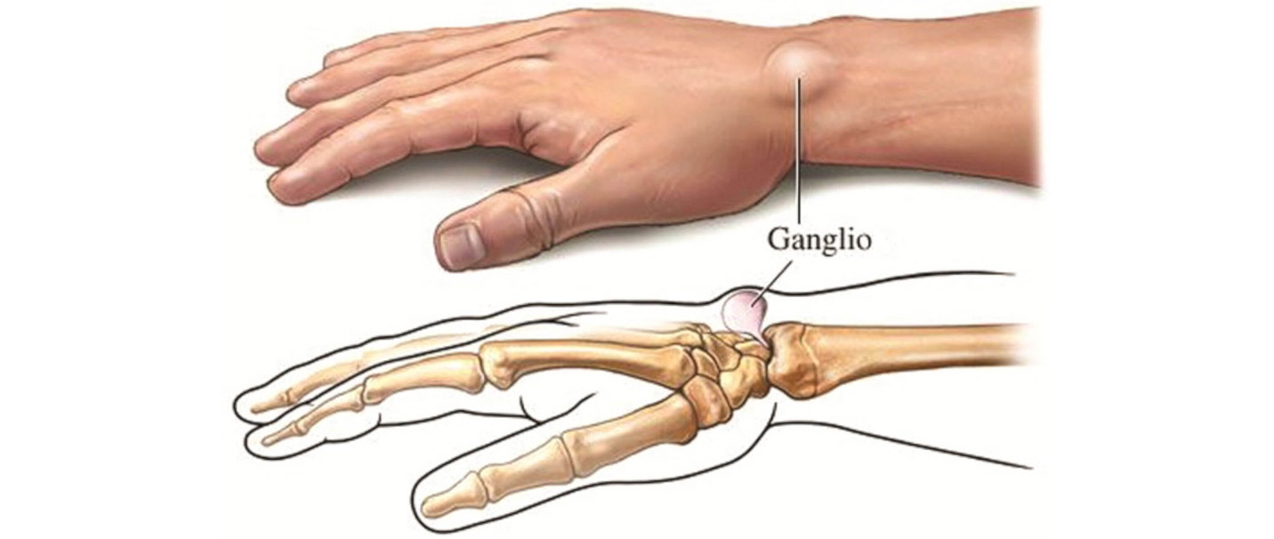 sąnarių skausmas riešo rankos kojų gydymas sąnariai