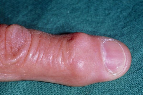 swollen painful joints in hands mazi nuo iš rankų sąnarių uždegimas