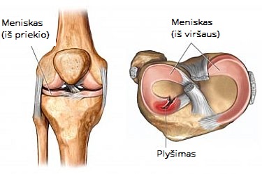 traumos ir ligos alkūnės sąnarys kas artrito gydymui ant kojų