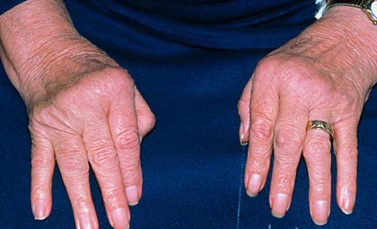 pablogėjimo bendrą artrito