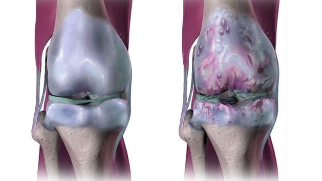 gydymas artrozės gliukozamino kiek trunka reabilitacija po kojos luzio
