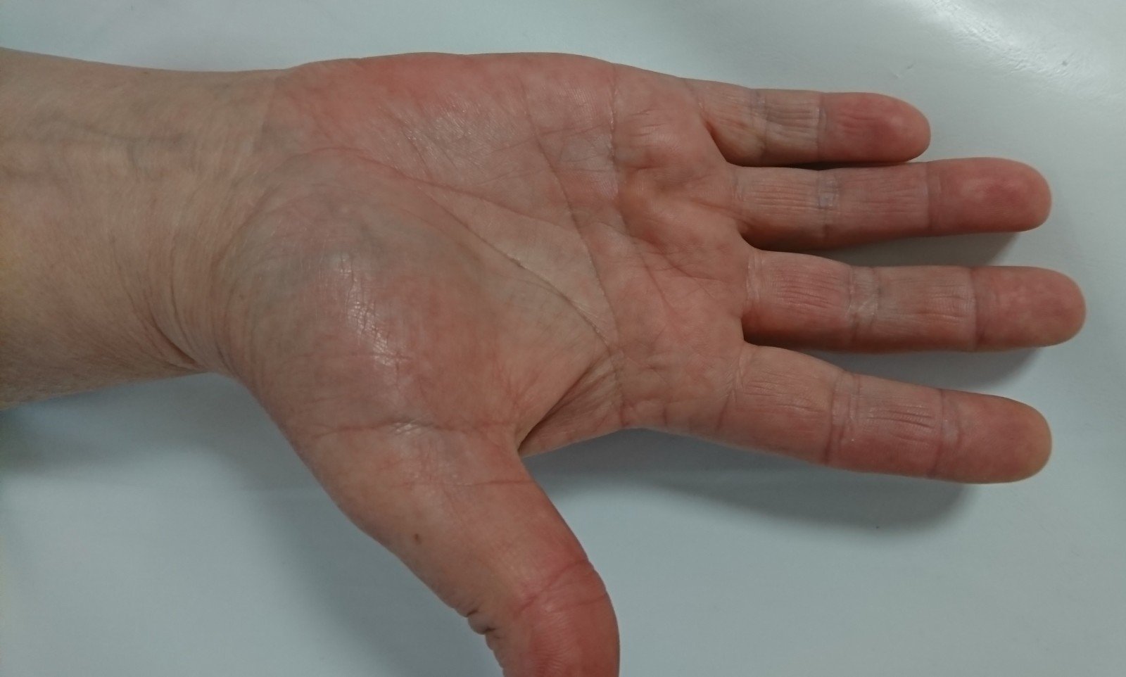 gerklės bendru didžiuoju pirštu ant rankos ką daryti gydymas artrozė šiluma