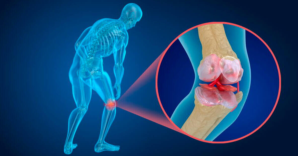 varžtas skausmas medicina sustav tinimas artrito metu