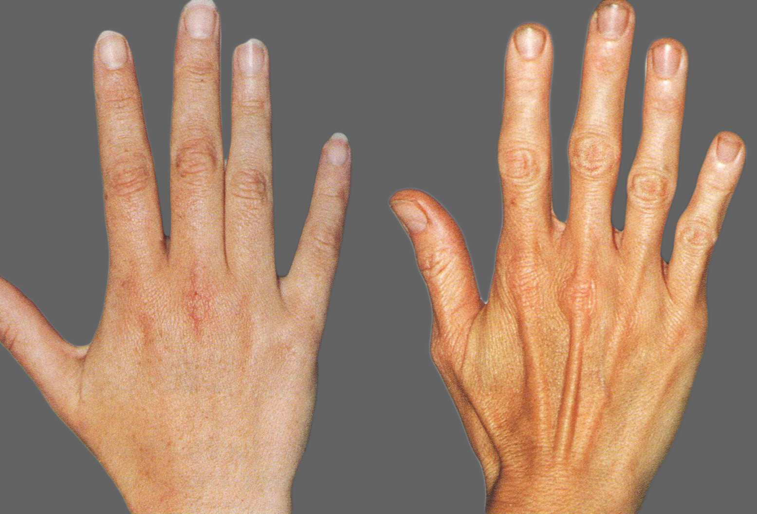artritas pirštu gydymas baltųjų lelijų sąnarių