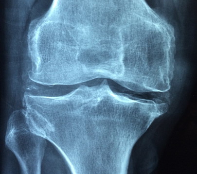 radiologinis gydymas artrozės sužeistas ir išsipūsti pėdos sąnarius