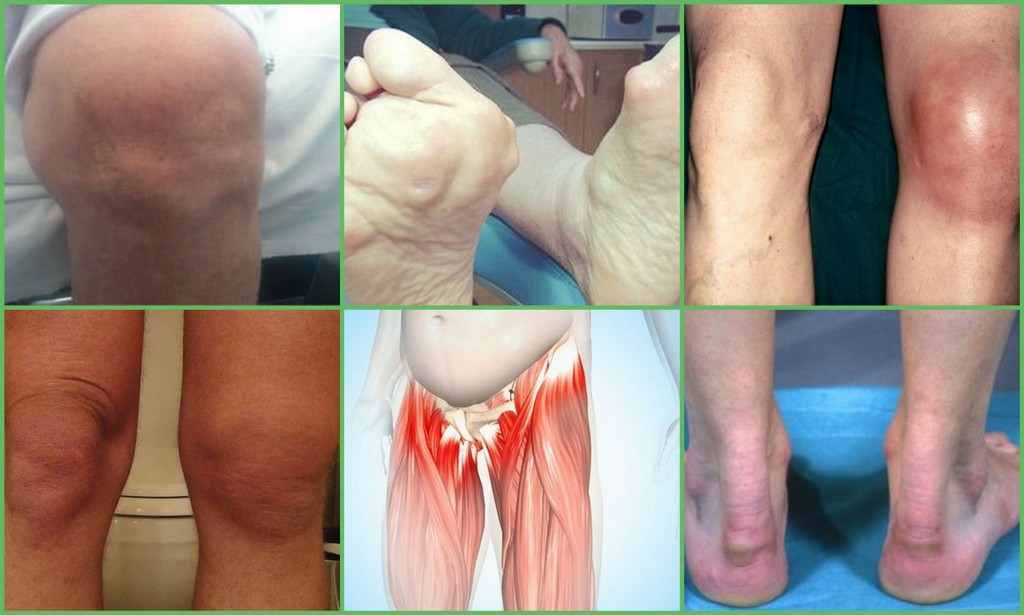 yaokb gydymas sąnarių artritas 3 alkūnės laipsnių