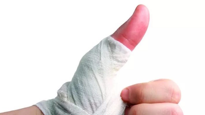 lėtinis artritas rankų šepečiai kas yra artrozė iš peties sąnario 1 laipsnis