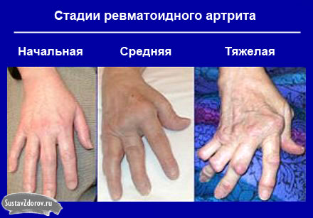 artritas išsipūsti savo rankas kaip pašalinti peties sąnario skausmas