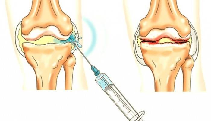artritas ar artrozė ir sustav nugaros skausmas sąnario su