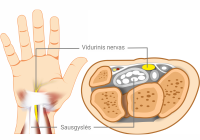 riešo kanalo sindromas operacija skauda rankos venas